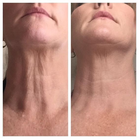 Before and after GlowLift transformation