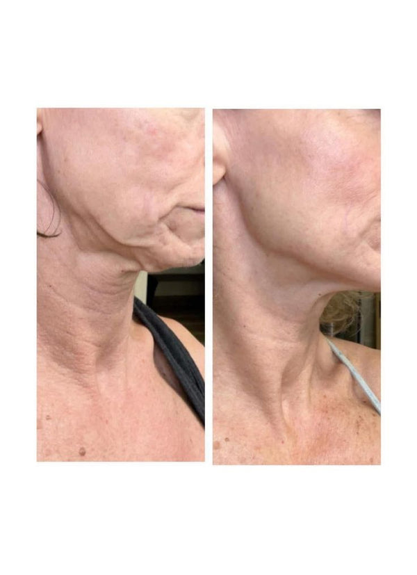 Before and after GlowLift transformation