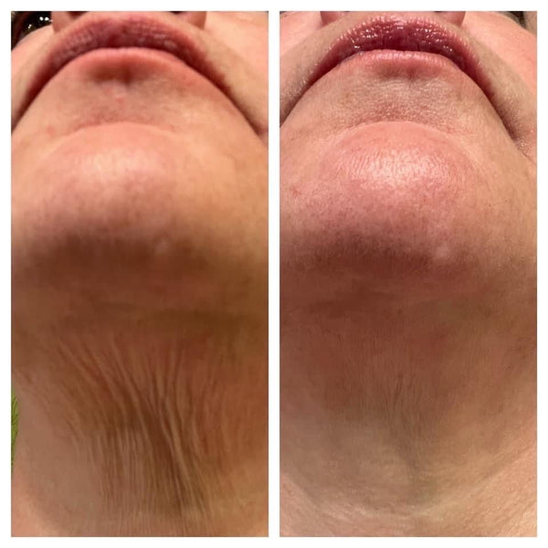 Before and after GlowLift transformation