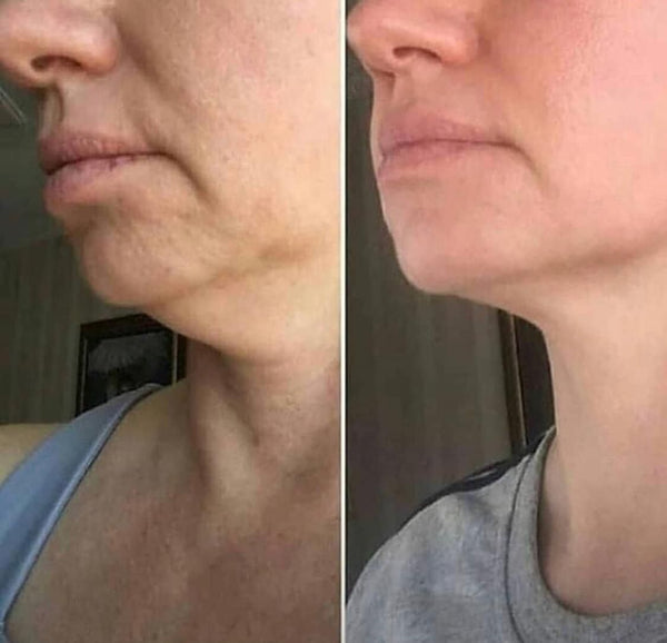 Before and after GlowLift transformation