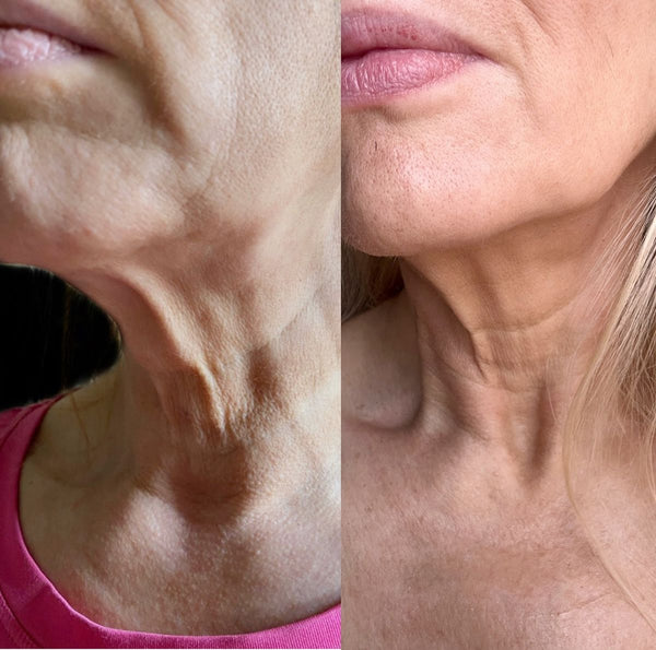Before and after GlowLift transformation