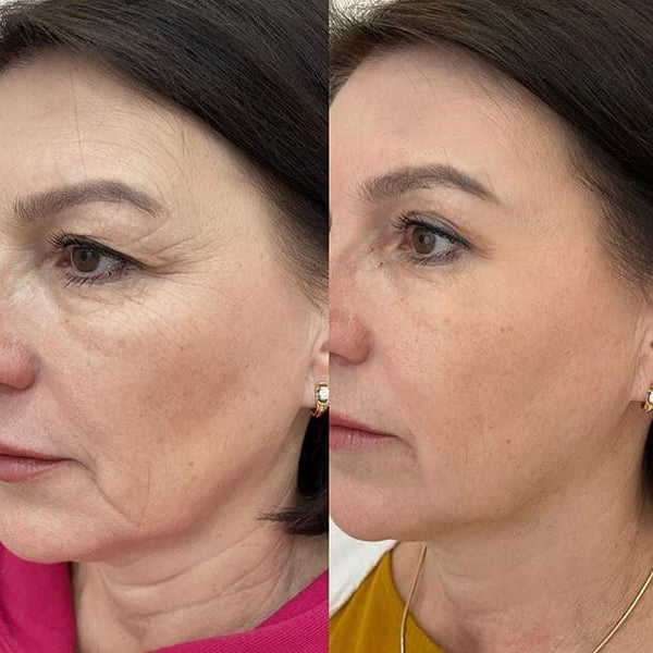 Before and after GlowLift transformation