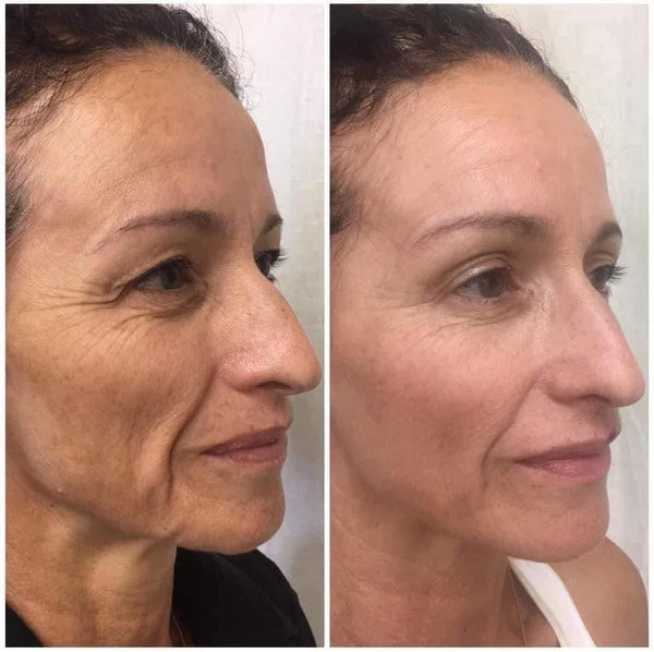 Before and after GlowLift transformation