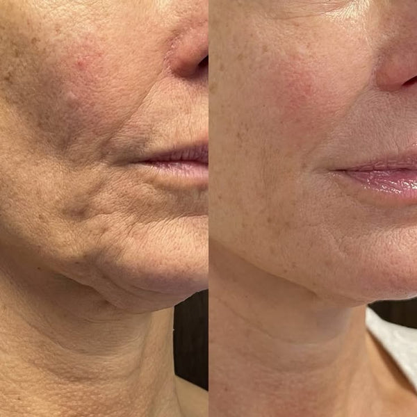 Before and after GlowLift transformation